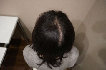 AGAスキンクリニックの症例写真[アフター]