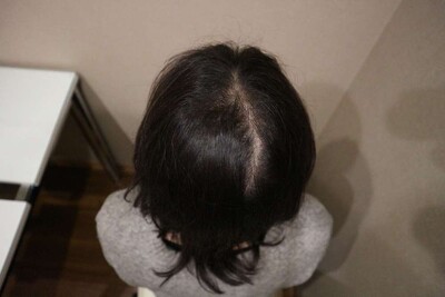 Rebirth+ミノキジェット｜30代｜4か月の症例写真[アフター]