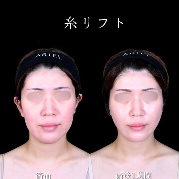 アリエル美容クリニック 大宮院のしわ・たるみ整形(注入、糸、フェイスリフト)の症例写真