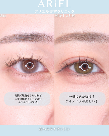 アリエル美容クリニック 横浜院の目・二重整形の症例写真