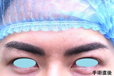 20代　男性　上まぶたの脂肪取り　（埋没法は行なわず）の症例写真[アフター]