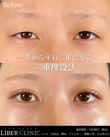 LIBER CLINIC （リベルクリニック）の目・二重整形の症例写真