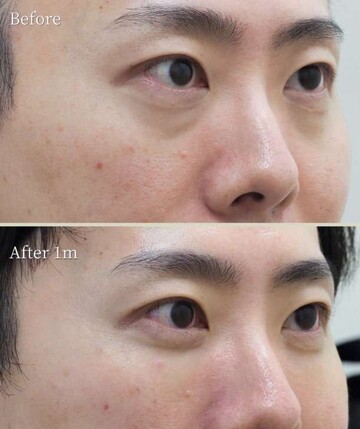 Theoryクリニック （セオリークリニック）の目元の症例写真