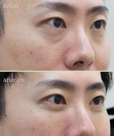【筒井院長】40代男性 脱脂術＋ピュアグラフティングの症例写真
