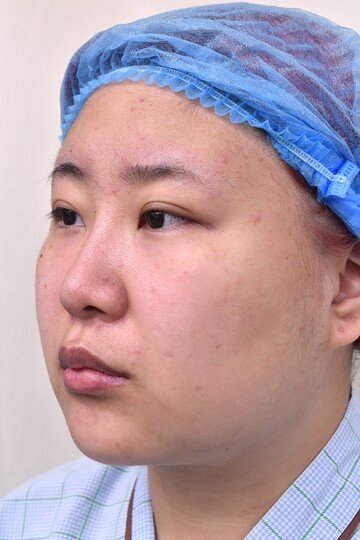 医療法人秀晄会 心斎橋コムロ美容外科クリニックの脂肪吸引の症例写真[ビフォー]