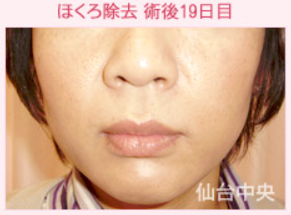 黒子除去 鼻の下の黒子 ほくろのレーザー治療の症例写真 画像 仙台中央クリニック Cs 美容医療の口コミ広場