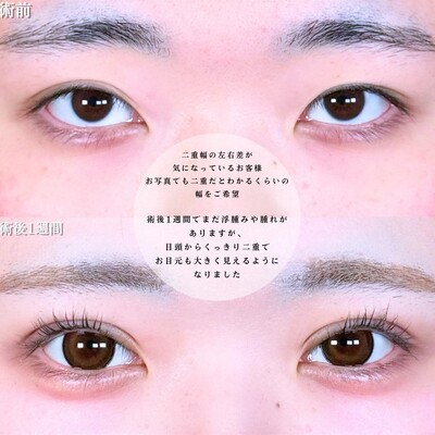 アリエルクイックループダブル二重埋没法の症例写真