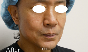 静岡美容外科橋本クリニックの症例写真[アフター]