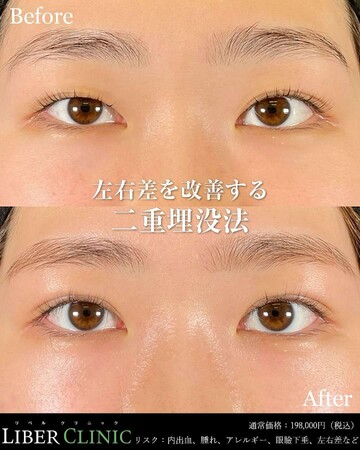 LIBER CLINIC （リベルクリニック）の目・二重整形の症例写真