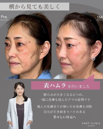KNOT CLINIC AOYAMAの目元・クマ・眉下・涙袋整形の症例写真