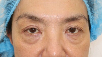 ハムラ法の症例写真[ビフォー]