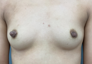 エースクリニックグループの乳首・乳輪の整形の症例写真[ビフォー]