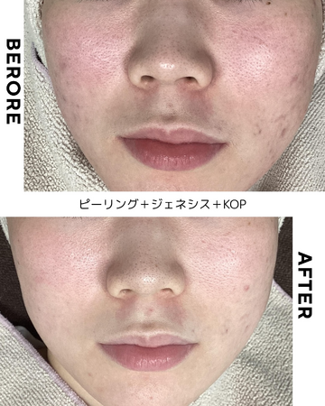 くみこクリニック 四条烏丸院のシミ取り・肝斑・毛穴治療の症例写真