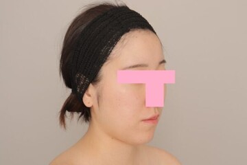 Mods Clinic (モッズクリニック)の脂肪吸引の症例写真[ビフォー]