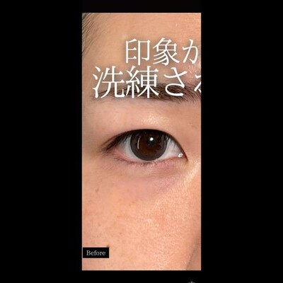 洗練された目元に🤭の症例写真[ビフォー]