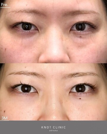 KNOT CLINIC AOYAMAの目元・クマ・眉下・涙袋整形の症例写真