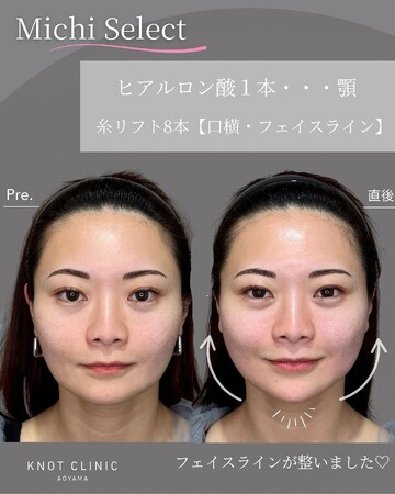 KNOT CLINIC AOYAMAのしわ・たるみ整形(注入、糸、フェイスリフト)の症例写真