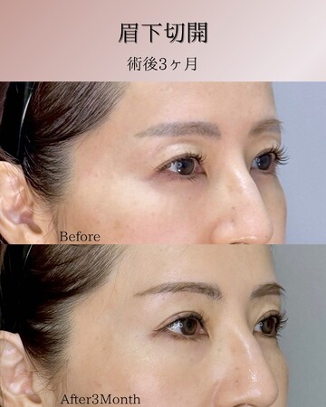 KNOT CLINIC AOYAMAの目元・クマ・眉下・涙袋整形の症例写真
