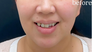 Plume Clinicの脂肪吸引の症例写真[ビフォー]