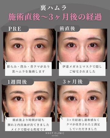 KNOT CLINIC AOYAMAの目元・クマ・眉下・涙袋整形の症例写真
