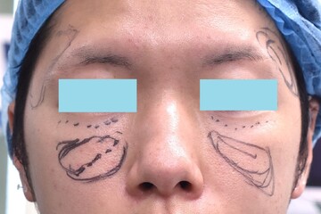 医療法人秀晄会 心斎橋コムロ美容外科クリニックのしわ・たるみ整形(注入、糸、フェイスリフト)の症例写真[ビフォー]