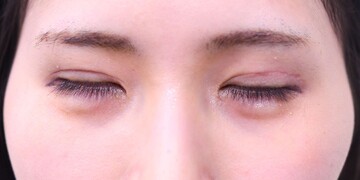 医療法人秀晄会 心斎橋コムロ美容外科クリニックの症例写真[アフター]