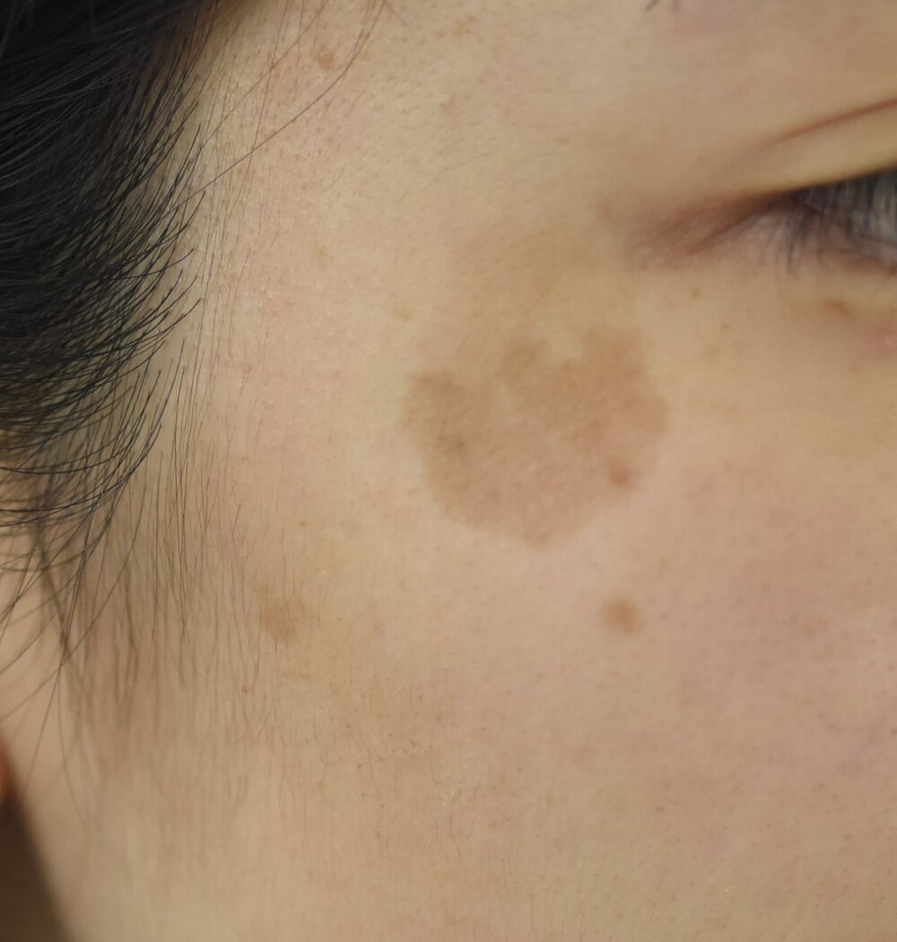 右こめかみの扁平母斑 ほくろ除去 あざ治療 イボ治療の症例写真 画像 みずほクリニック Cs 美容医療の口コミ広場