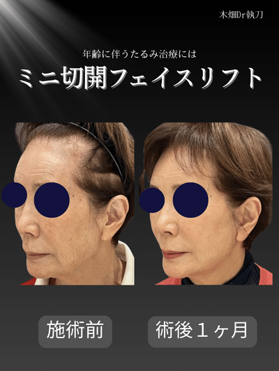ミニ切開フェイスリフトの症例写真