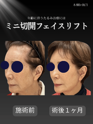 CHARIS BEAUTY CLINICのしわ・たるみ整形(注入、糸、フェイスリフト)の症例写真