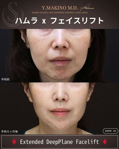 目元とフェイスラインを同時に引き上げる複合手術の症例写真