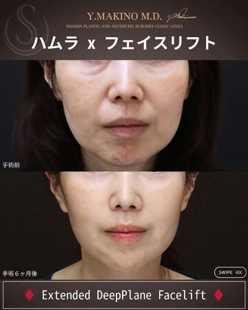 聖心美容クリニックのしわ・たるみ整形(注入、糸、フェイスリフト)の症例写真