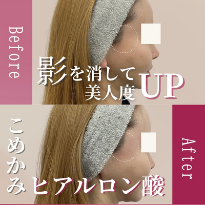 ヒアルロン酸注入の症例写真