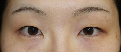 二重まぶた　切開法の症例写真
