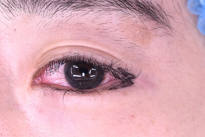 30代　女性　目尻切開　W法　　2.5㎜幅の症例写真[ビフォー]