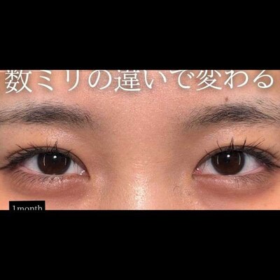数ミリの違いで印象変わる☺️の症例写真[アフター]