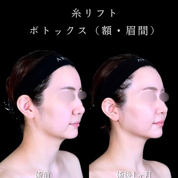 アリエル美容クリニック 大宮院のしわ・たるみ整形(注入、糸、フェイスリフト)の症例写真