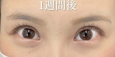 福山医師によるフォーエバー二重術の症例写真[アフター]