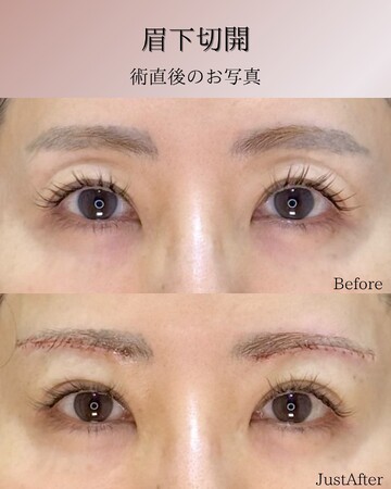KNOT CLINIC AOYAMAの目元・クマ・眉下・涙袋整形の症例写真