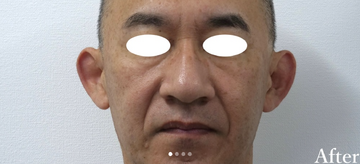 静岡美容外科橋本クリニックの症例写真[アフター]