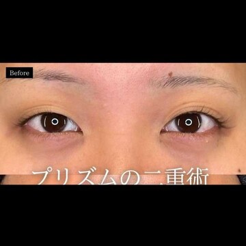 PRISM Beauty Clinicの二重の症例写真[ビフォー]