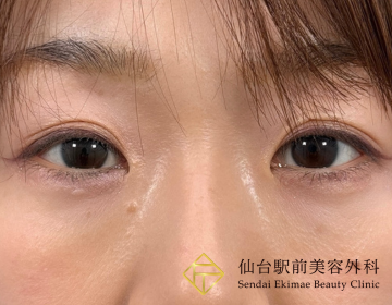 仙台駅前美容外科の症例写真[アフター]