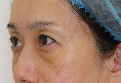 脱脂+CRF注入の症例写真[ビフォー]