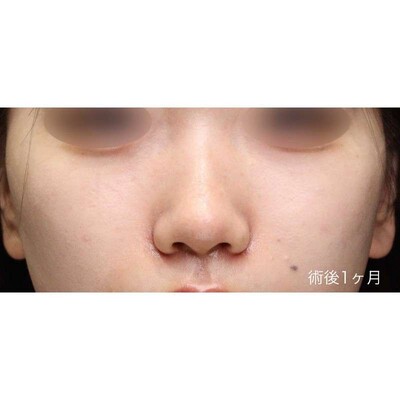 土手を温存した小鼻縮小（内外側法）で自然な小鼻にの症例写真[アフター]