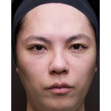 聖心美容クリニックの目元の症例写真[ビフォー]