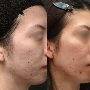 豊洲内科・糖尿病／形成・美容外科クリニックのニキビの症例写真