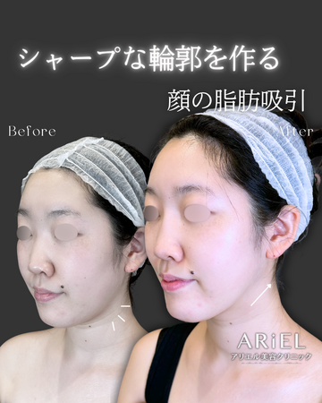 アリエル美容クリニック 郡山院の輪郭・顎・エラ・額・小顔整形の症例写真