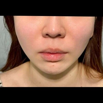 アルテミスリフト８本の症例写真[アフター]