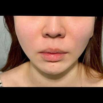 PRISM Beauty Clinicの症例写真[アフター]