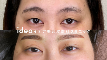 イデア美容皮膚科クリニックのアートメイクの症例写真