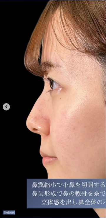 PRISM Beauty Clinicの鼻の整形の症例写真[ビフォー]